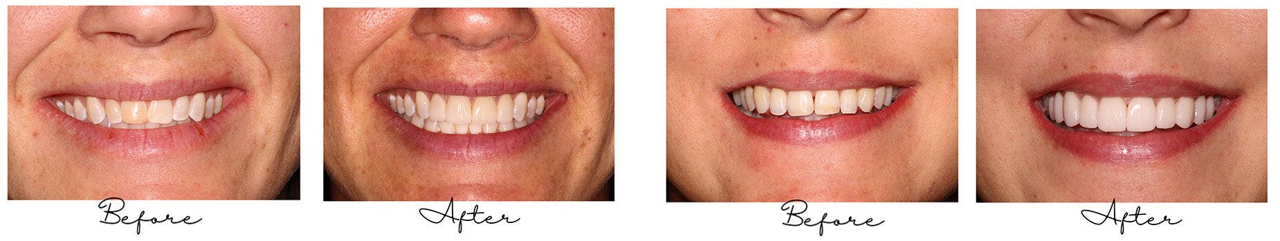 Cosmetic Dentistry - Before-After - at Vitality Family Dental Kansas City